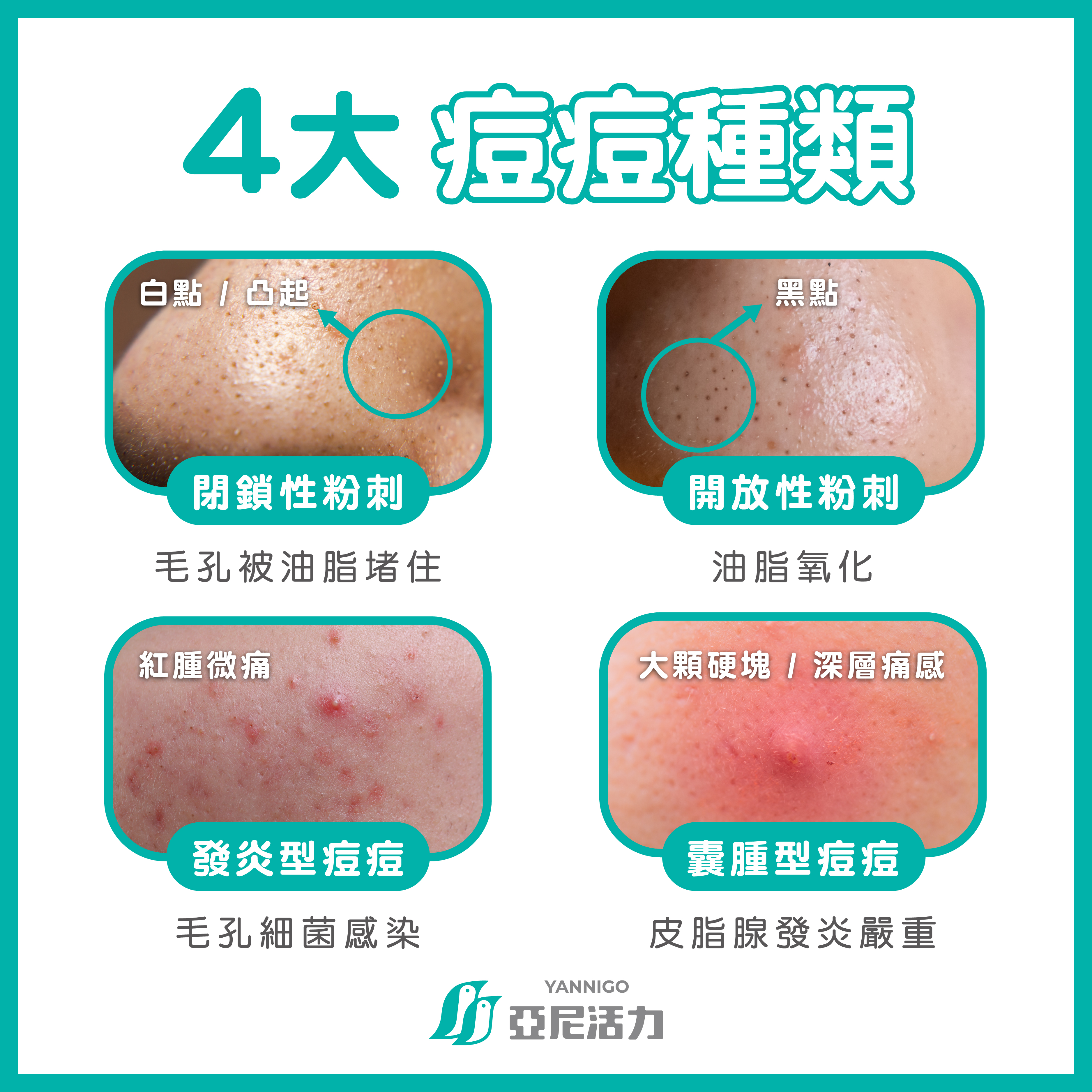4大痘痘種類 閉鎖性粉刺 開放性粉刺 發炎型痘痘 囊腫型痘痘